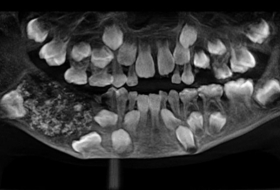   Medizinische Sensation in Indien: Ärzte entfernen Siebenjährigem 526 Zähne –   Fotos    
