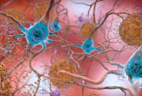   Kann Alzheimer übertragen werden?  
