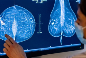   Brustkrebsvorsorge wird ausgeweitet  