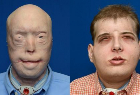 Bisher umfassendste Gesichtstransplantation in den USA