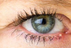 Augenentzündung – das hilft jetzt