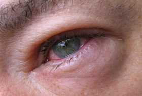 Augengrippe: Symptome und Behandlung