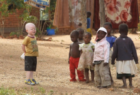 18 Albinos in Malawi getötet
