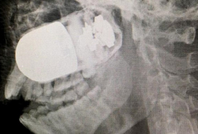 Ärzte entfernen scharfe Granate aus Kopf