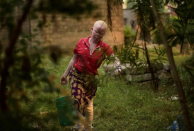 Die Insel der Albinos ist ihre letzte Zuflucht